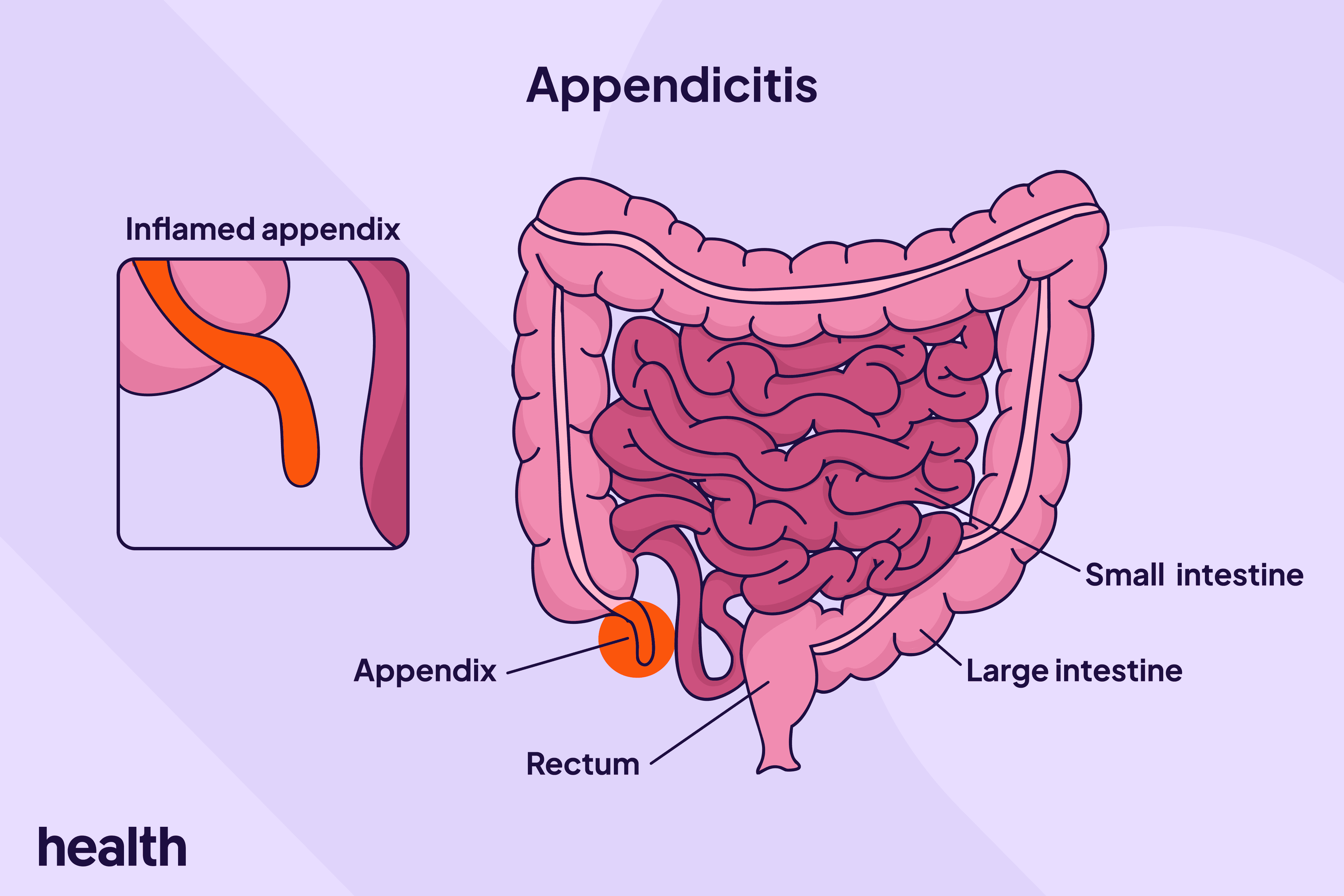 Understanding Appendicitis: Causes, Symptoms, and Management