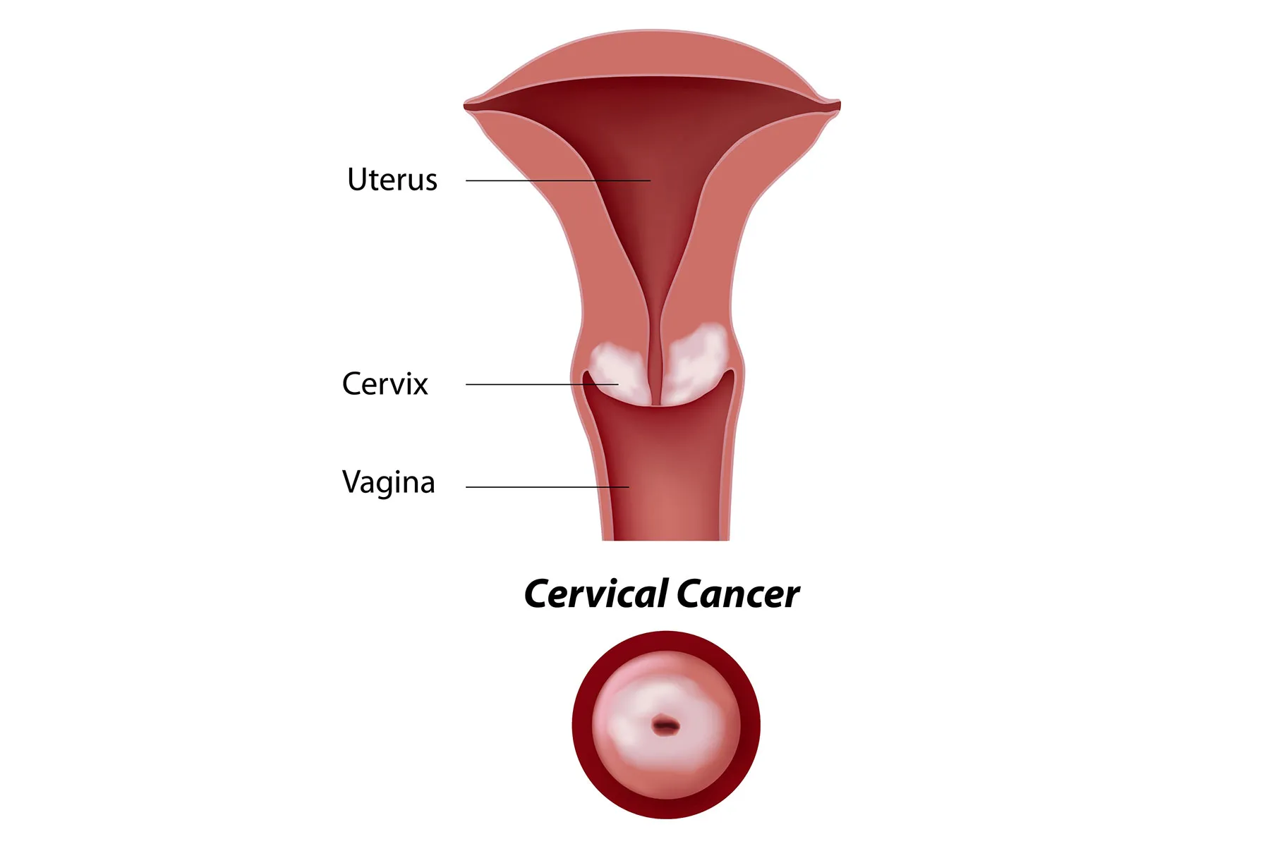 Cervical Cancer: Awareness, Prevention, and Treatment