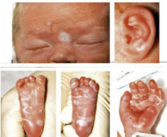 Neonatal Syphilis:Congenital Syphilis