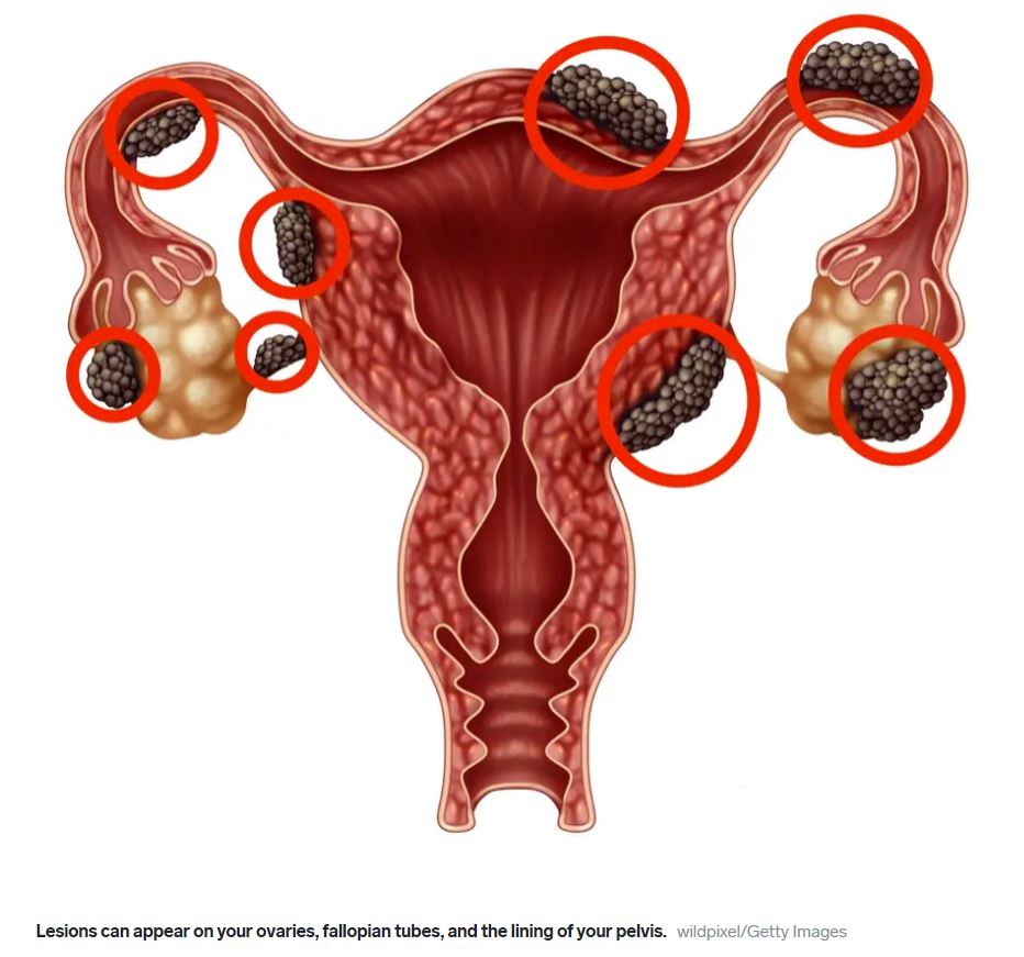 Endometriosis: Understanding the Silent Struggle Many Women Face