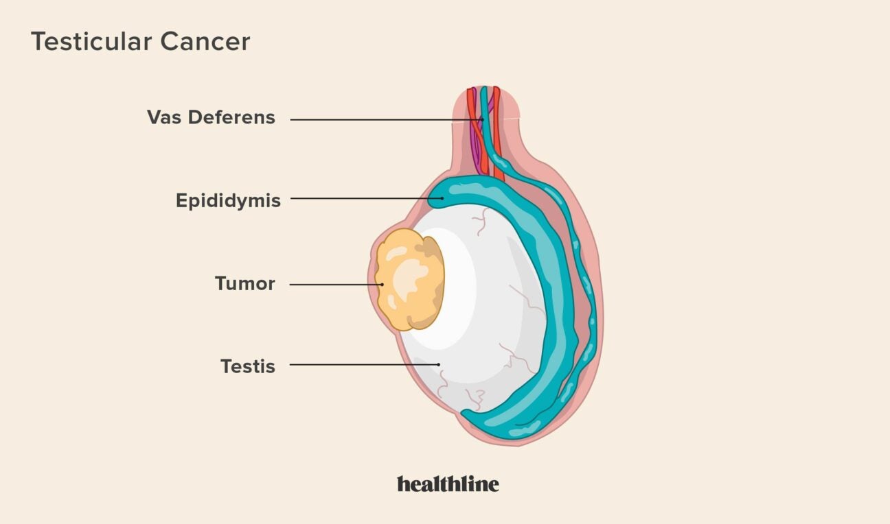 Can SHA Cover Testicular Cancer?