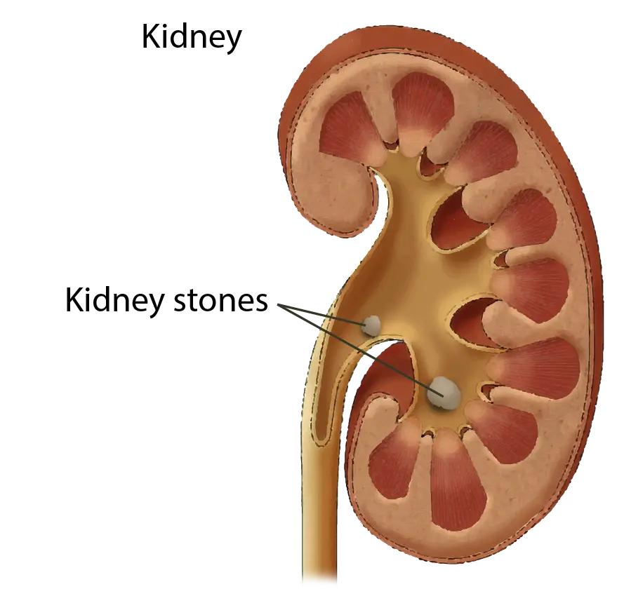 The Silent Sting: Understanding the Physical and Financial Cost of Kidney Stones